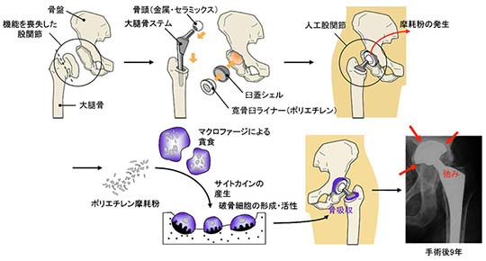 図1  人工股関節手術と弛みの発生機序